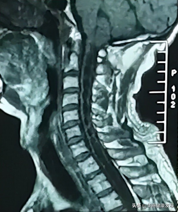 颈部疼痛的原因(颈部疼痛不适长达11年，本以为是颈椎病，没想到竟是先天性疾病……)