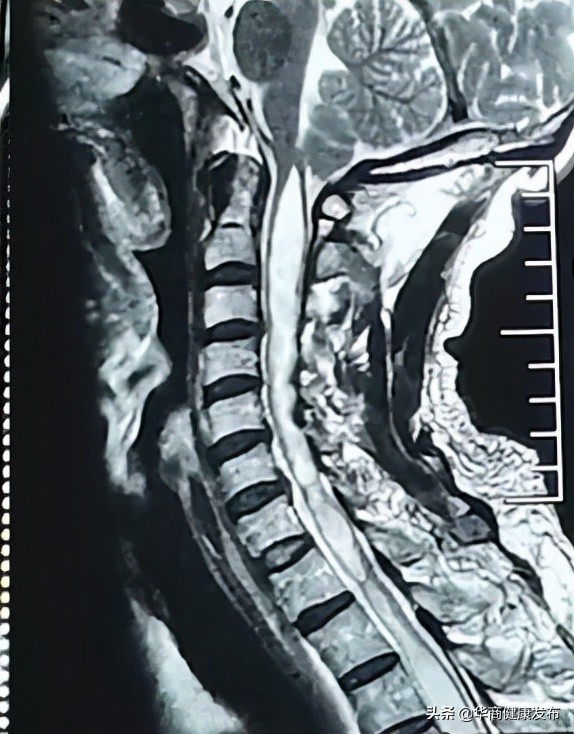 颈部疼痛的原因(颈部疼痛不适长达11年，本以为是颈椎病，没想到竟是先天性疾病……)