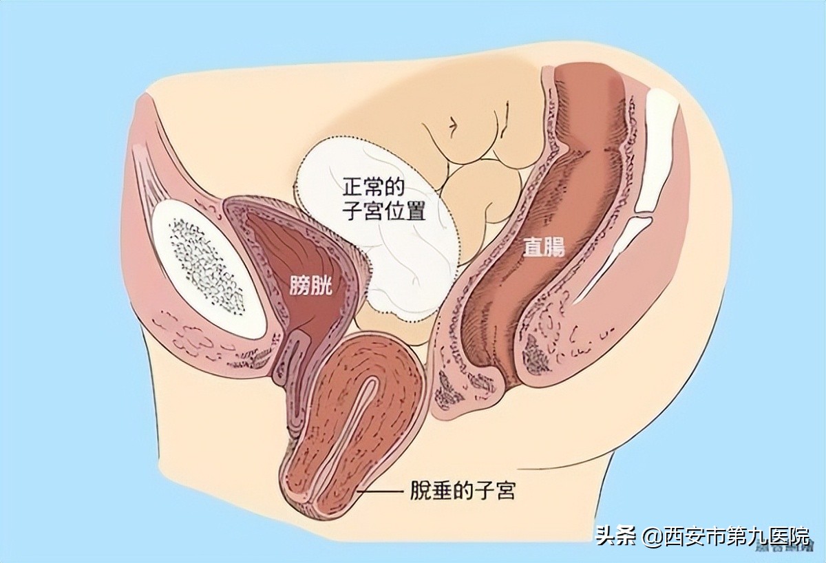 特色技术展示｜骶棘韧带悬吊术在子宫脱垂患者中的应用