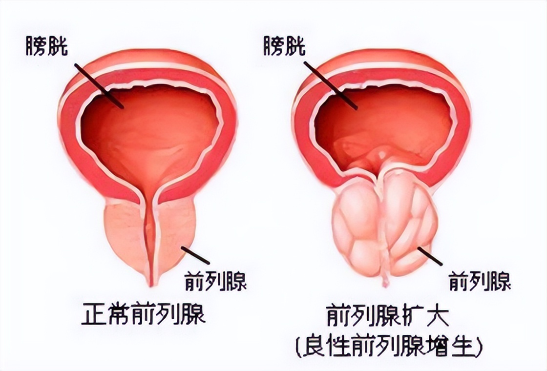 前列腺增生和前列腺炎,一字之差,兩個用藥方案,您用對了嗎?