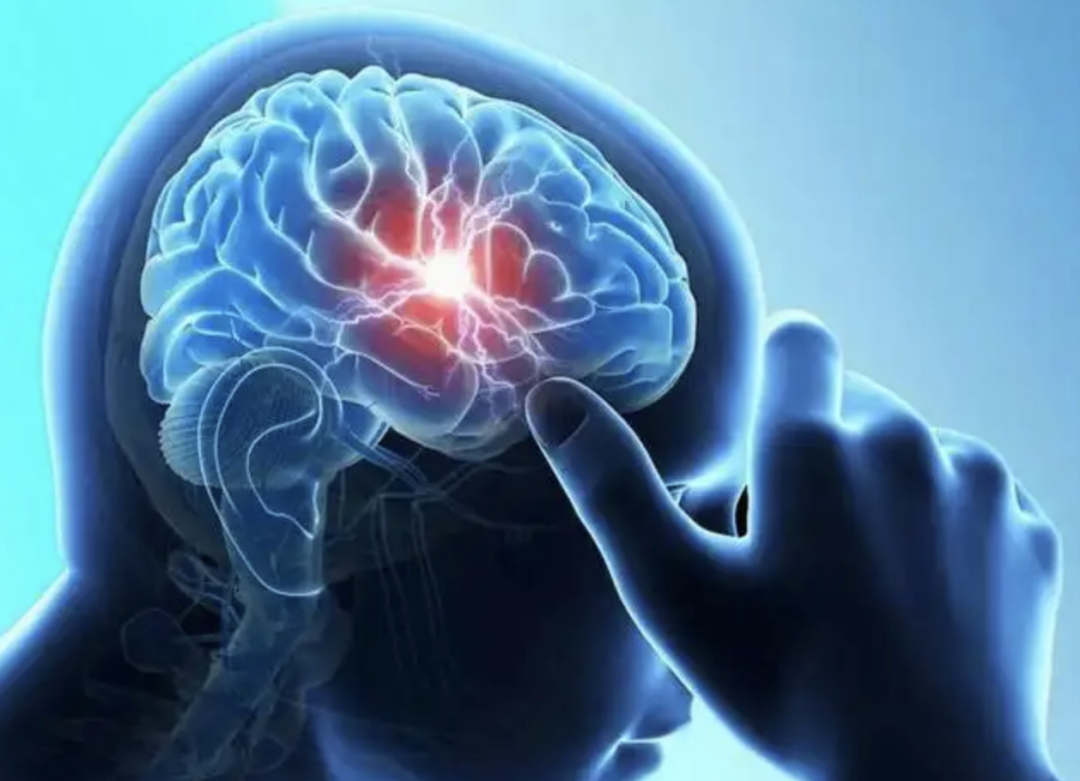 中美双认证！这款AI产品“争分夺秒”治疗脑卒中