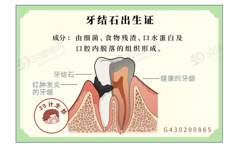 牙齿上的“小石头”，怎么去除好得快？真正有用的方法是这2个