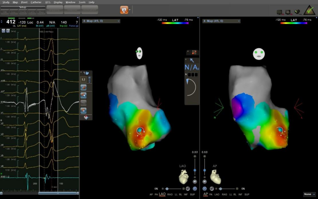 仁医病例丨方哲参与指导多例疑难性室早射频消融治疗