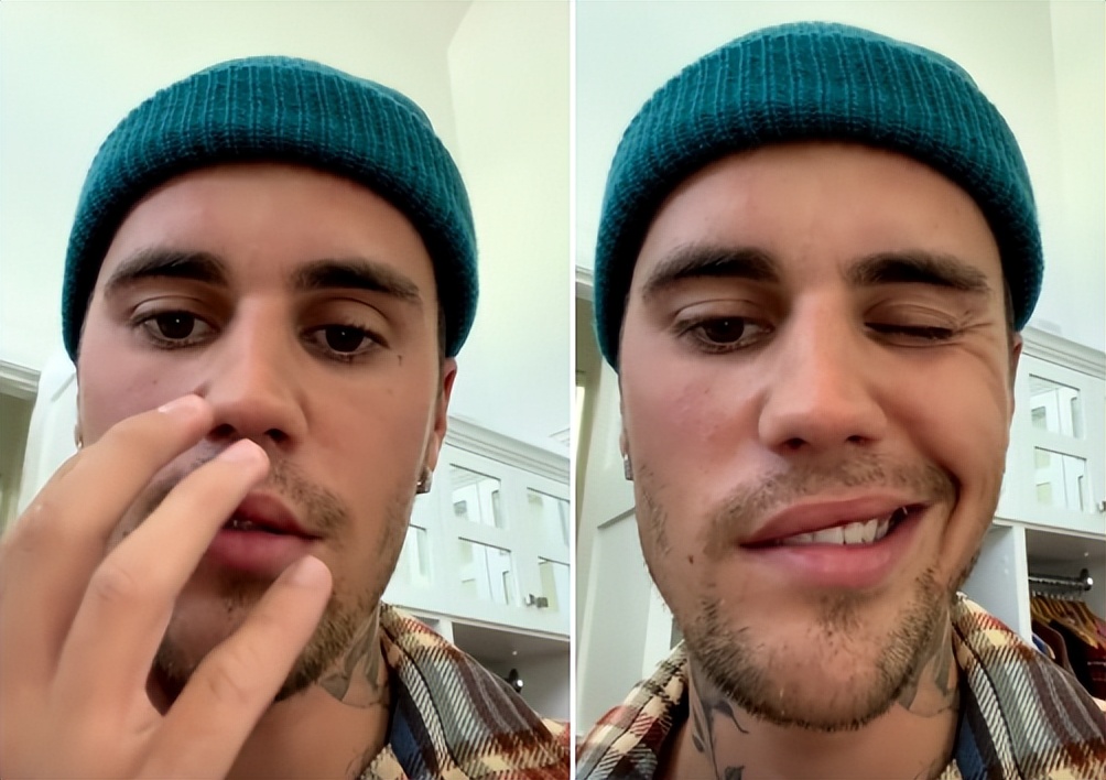 贾斯汀比伯自曝患病面瘫!半边鼻子嘴巴不能动,表情僵硬说话缓慢