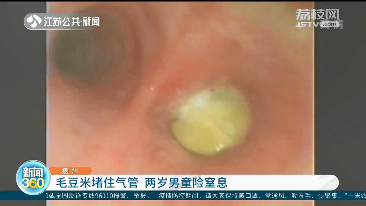 毛豆米堵住气管，肺部只剩一边能工作 扬州两岁男童险窒息