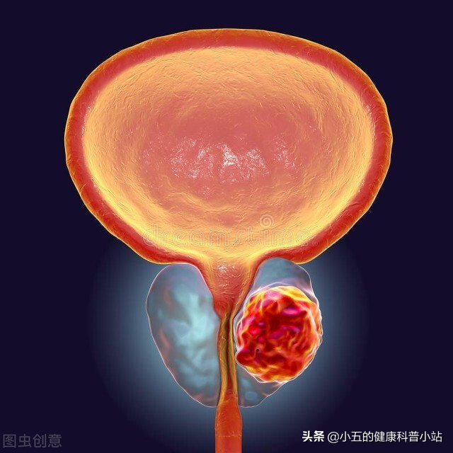 坦索罗辛和非那雄胺是治疗前列腺增生的常用方案，为什么要联用？