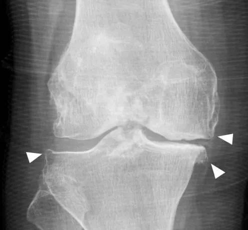 体检查出这19种疾病，医生：其实根本不用治！别再花冤枉钱