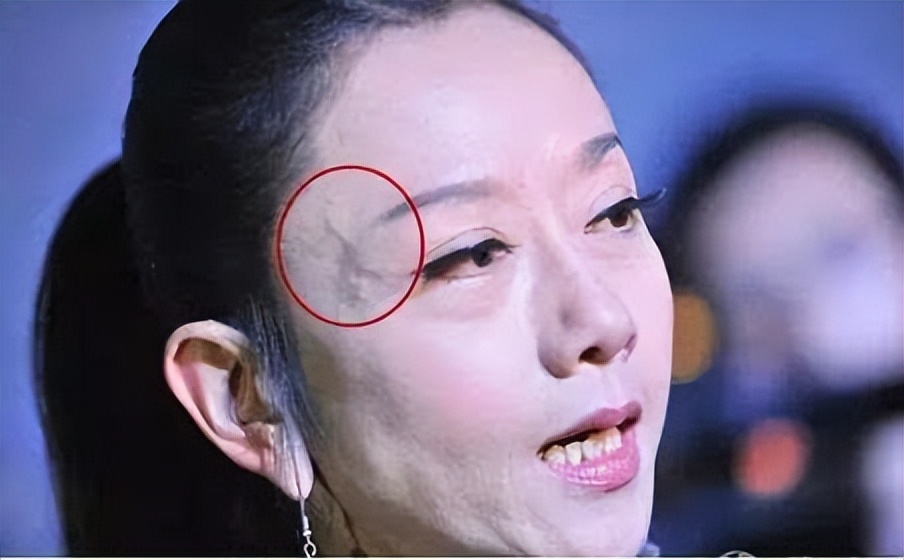 有些人手臂"青筋暴起",有些人却看不到"青筋",医生为你科普