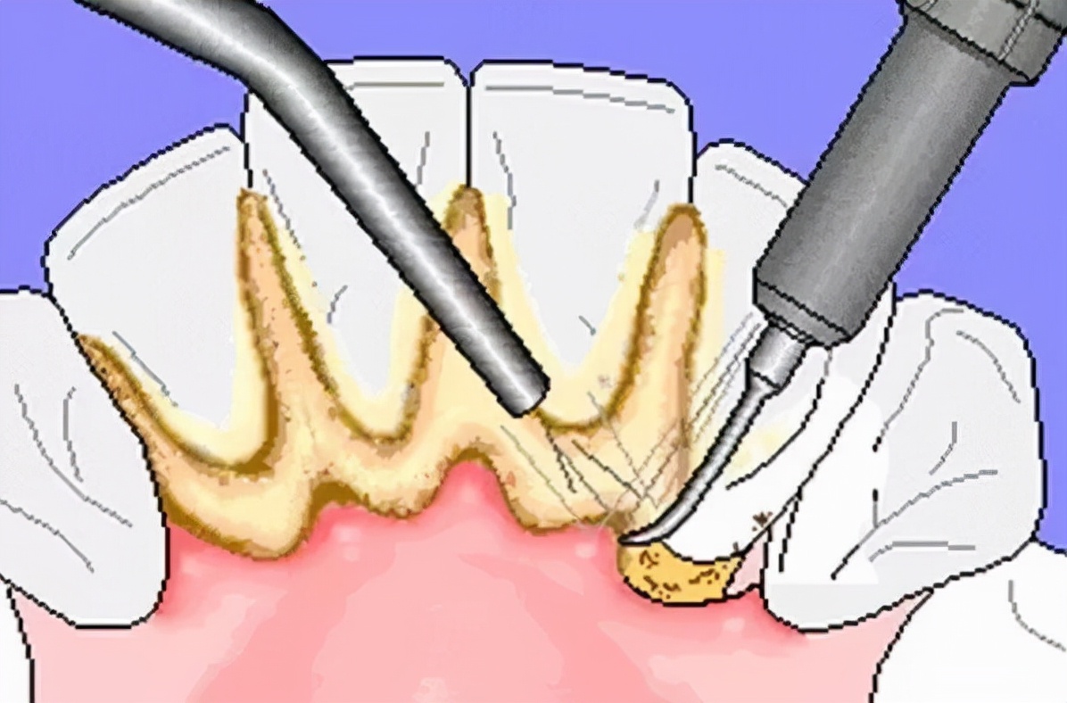 自己怎样清理牙结石牙结石可以自己抠掉吗教你几招牙缝脏东西或能轻松