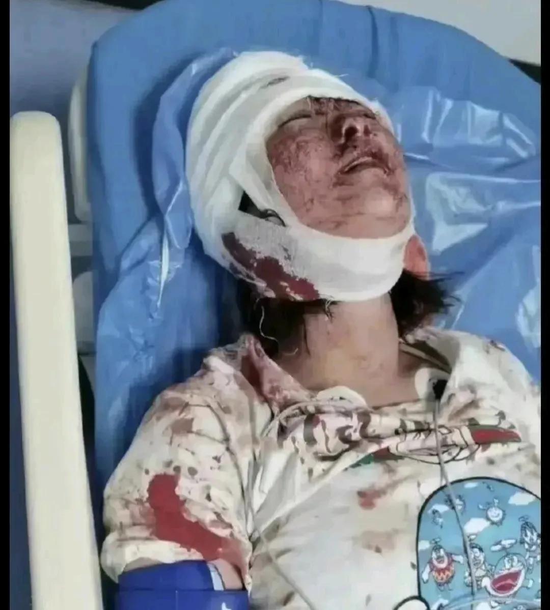 唐山烧烤店被殴打的女子如今伤势如何？