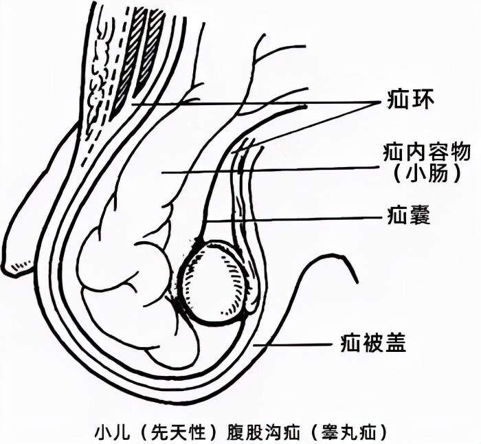 男宝宝疝环口位置图片图片