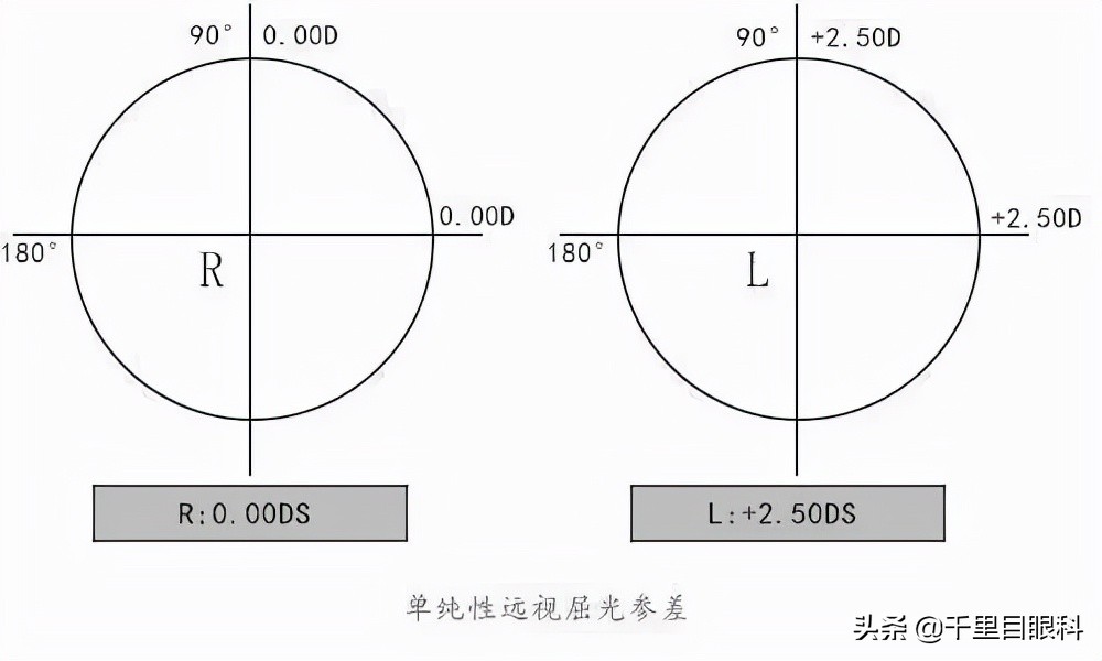 双眼近视度数差异大，会严重威胁视力