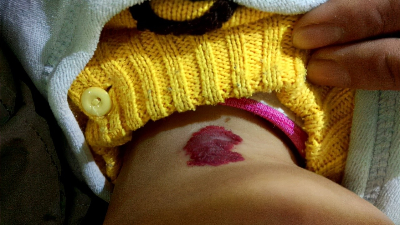 郑家伟婴儿血管瘤(宝宝身上长红痣) - 乐宝宝贝