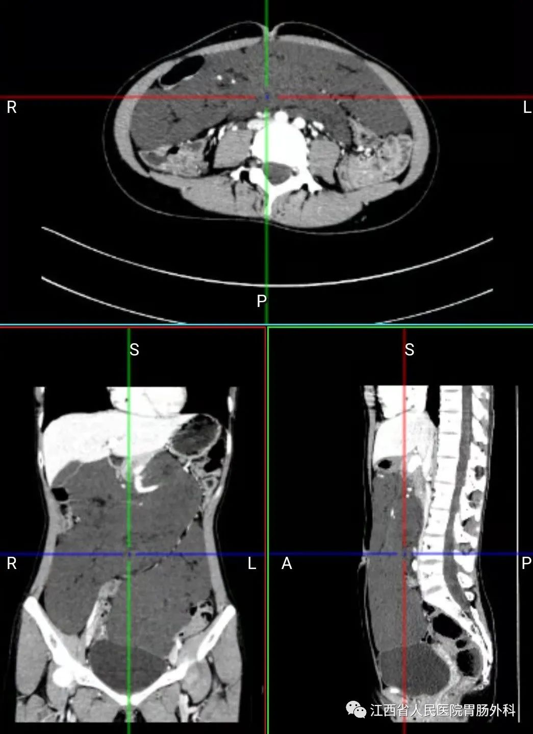 花季少女腹藏巨大肿瘤！省人民医院精心“拆弹”解难题