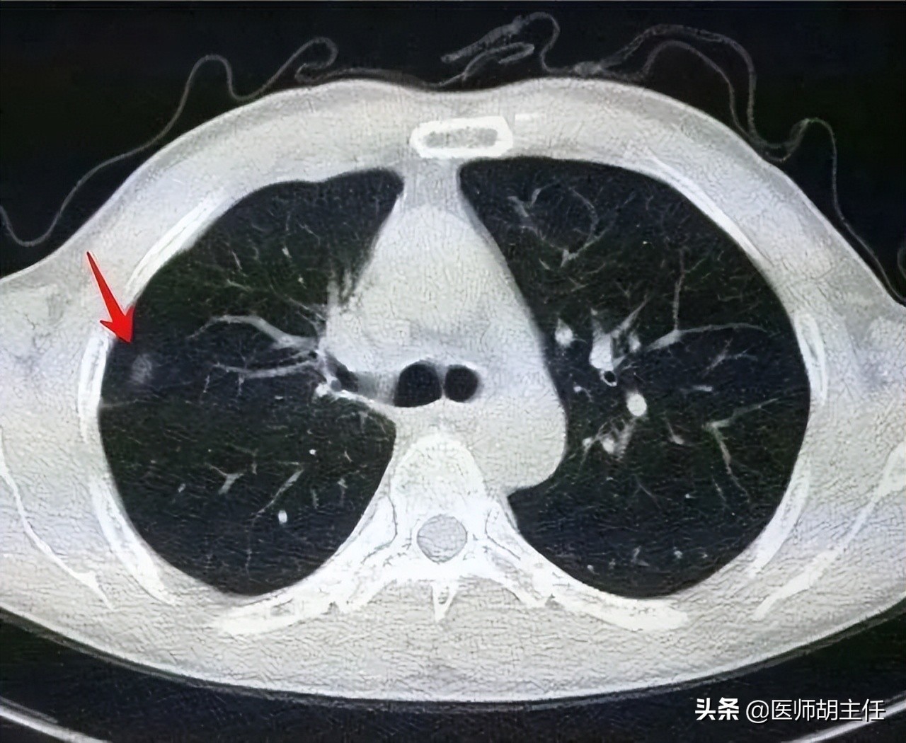 肺有癌，睡觉能提前预知？若出现这4种现象，劝你早做CT检查