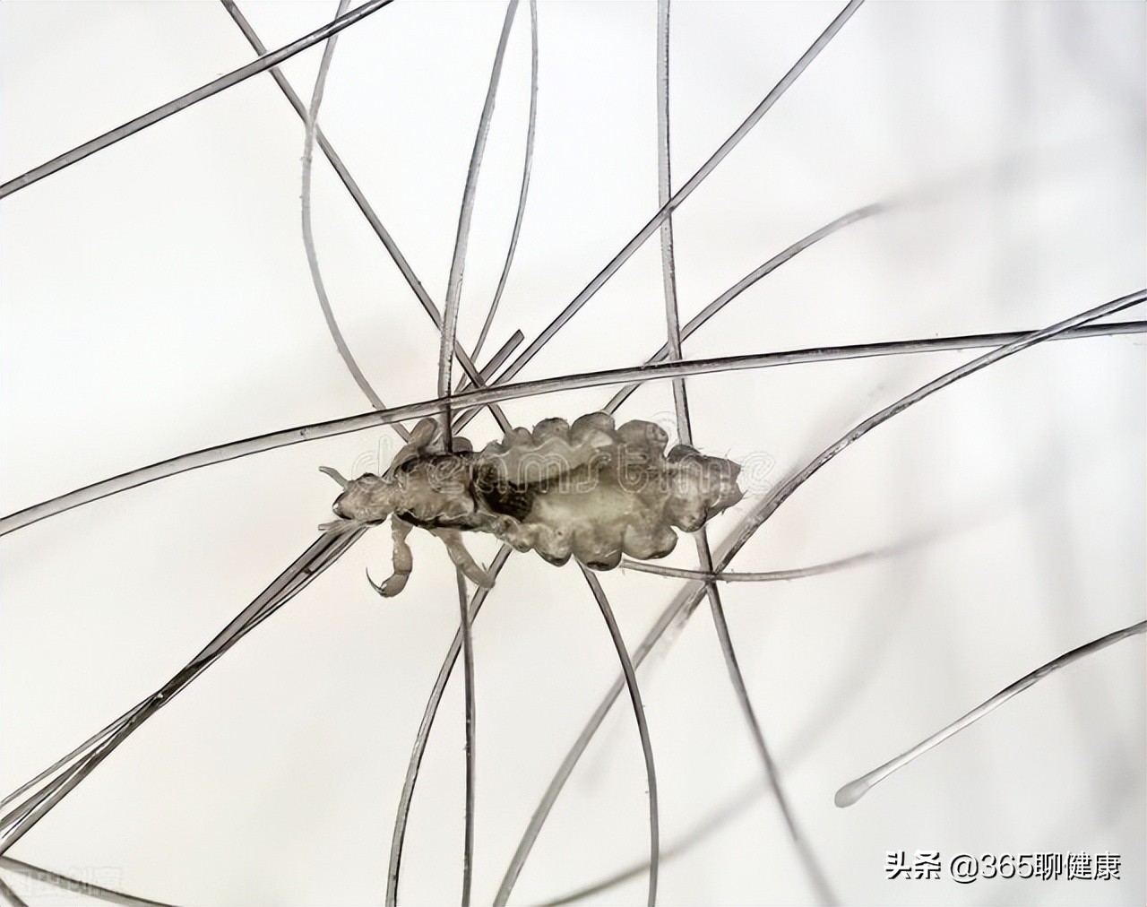 为何有的女孩会被阴虱盯上?与这2点有重要关系