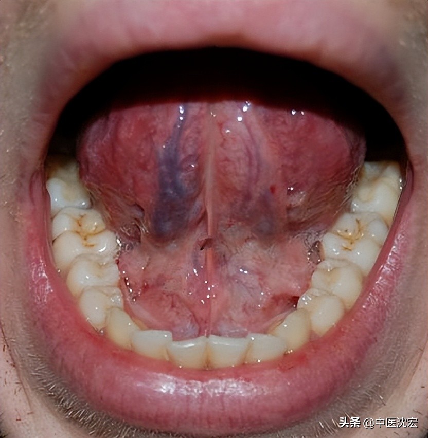 舌头下面的颜色图片