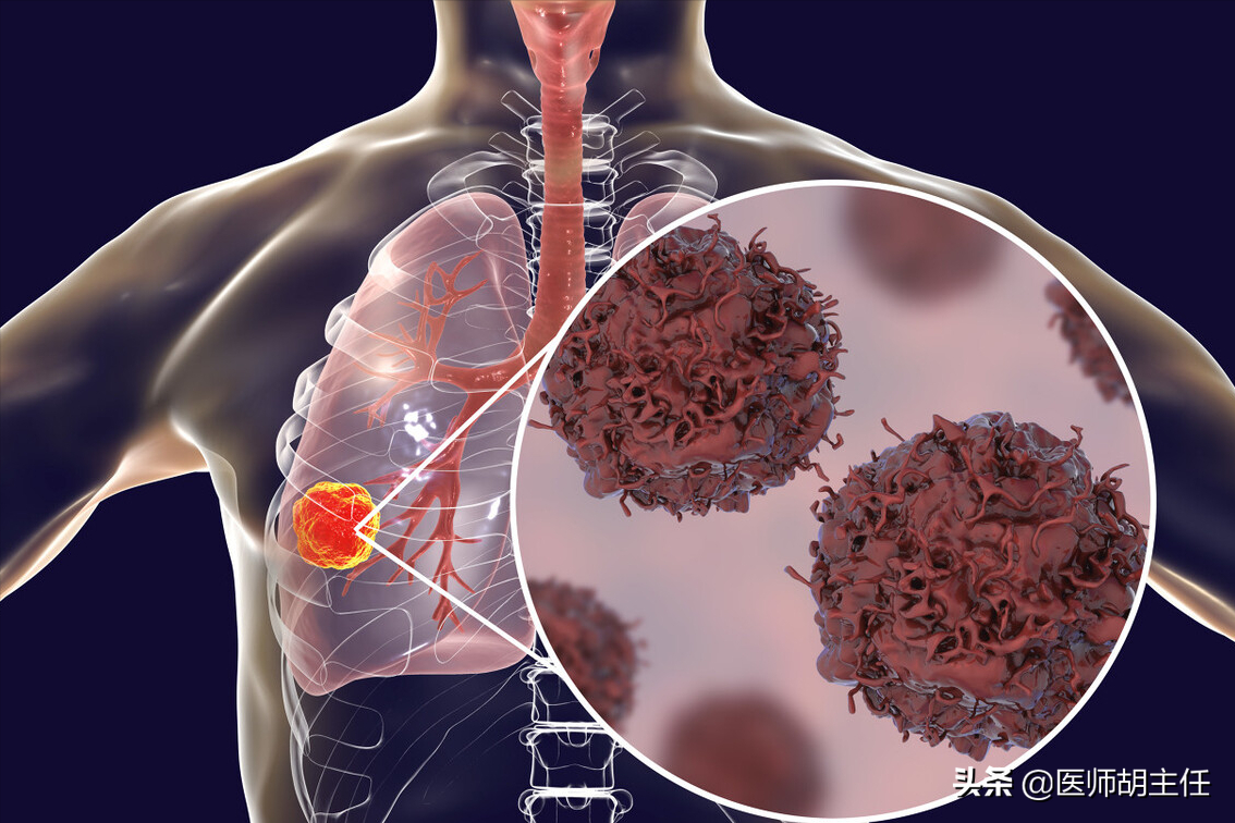 肺有癌，睡觉能提前预知？若出现这4种现象，劝你早做CT检查