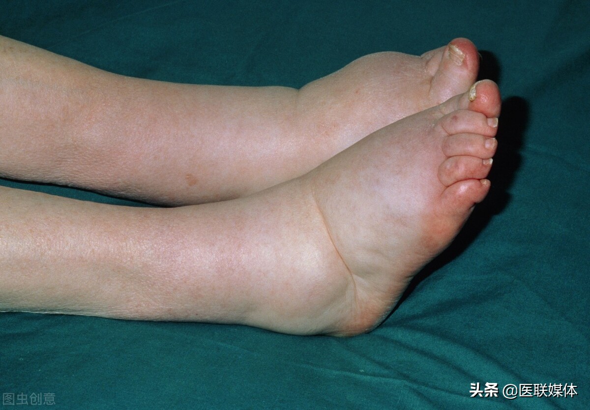 下肢浮肿是怎么回事 下肢浮肿的原因(下肢浮肿牵连的4种疾病) | 说明