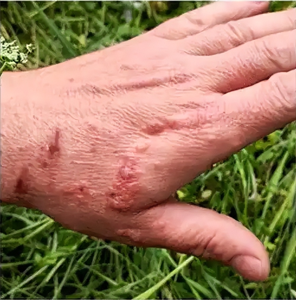 2015年,英国小女孩春游碰到一株植物,皮肤溃烂,引发三级烧伤