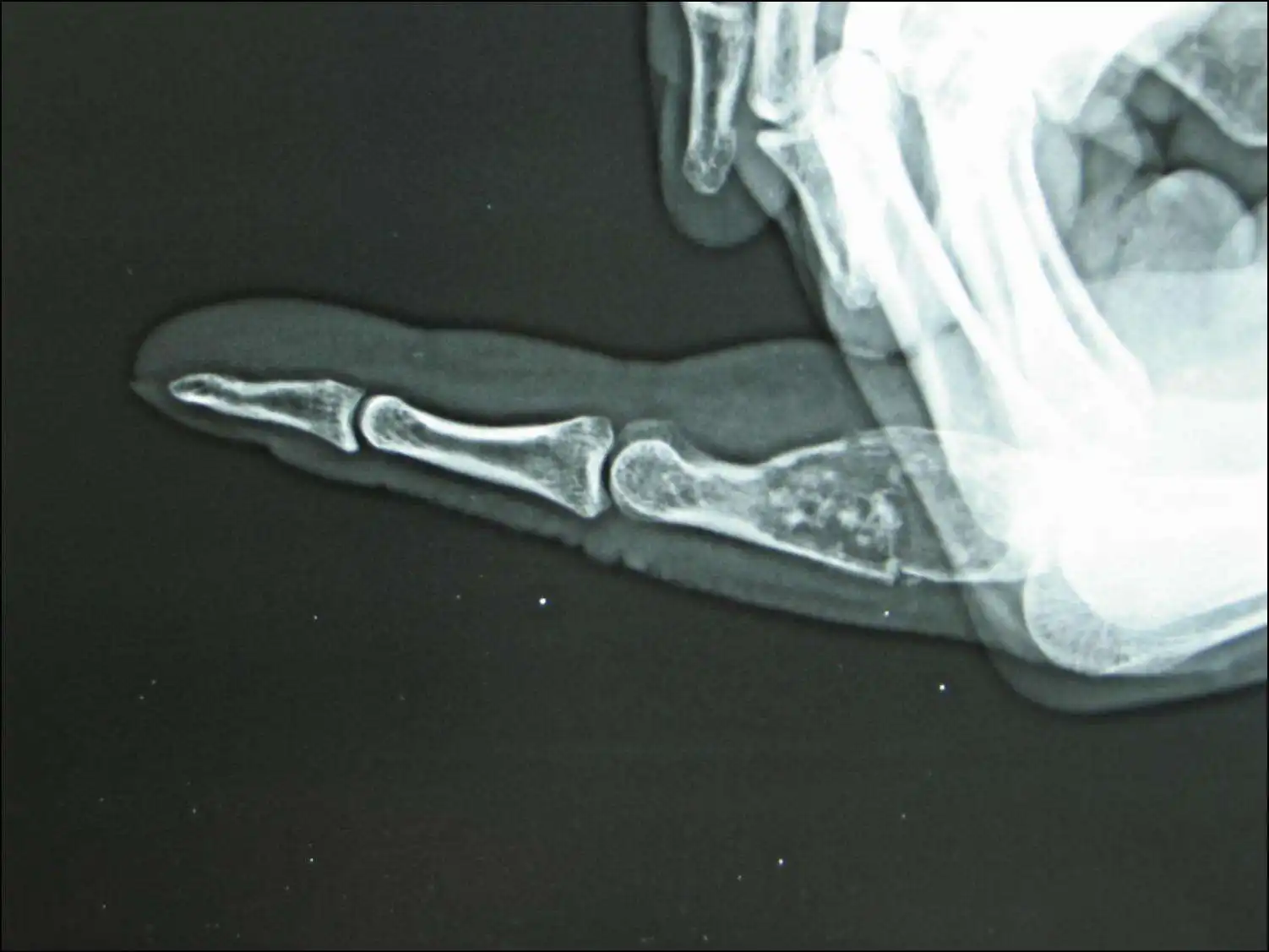 的内生性软骨瘤生长缓慢,体积较小,在引起手部变形之前可以长期无症状