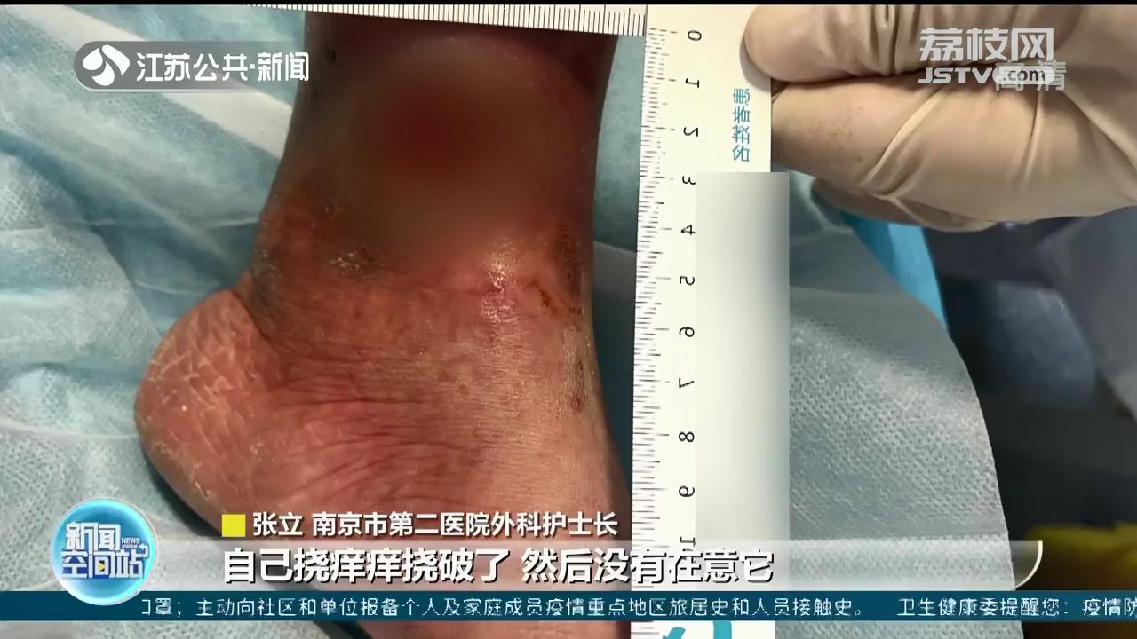 女子挠破蚊虫包导致溃烂 医生：血糖高伤口难愈合