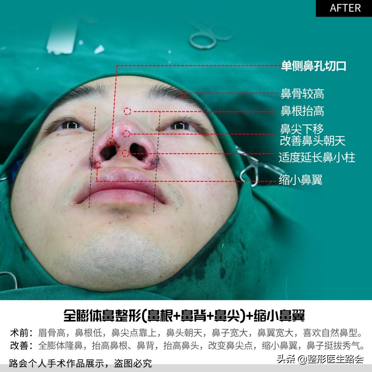 等待2年之久，从海南到北京，鼻整形真实记录，82天后“很惊艳”