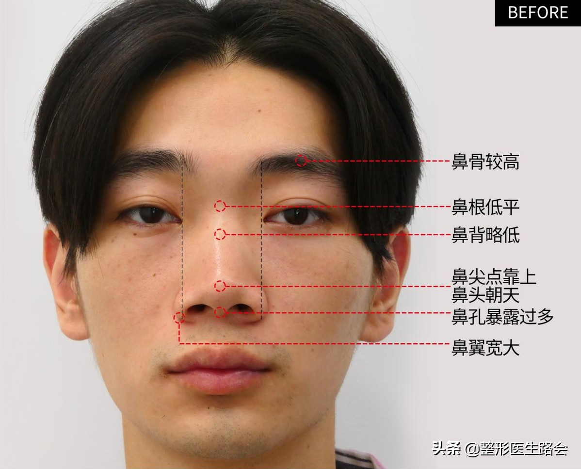 等待2年之久，从海南到北京，鼻整形真实记录，82天后“很惊艳”