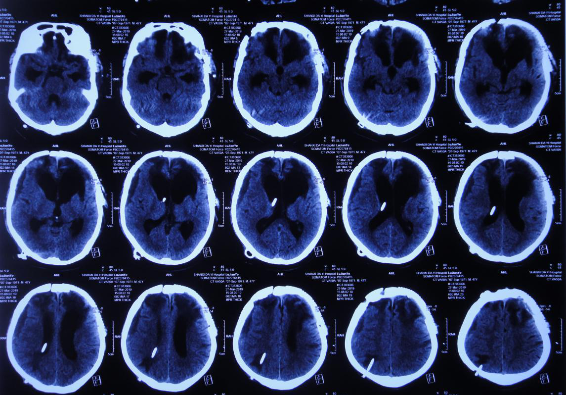 脑外伤颅骨修补术和分流术后脑积水加重致昏迷