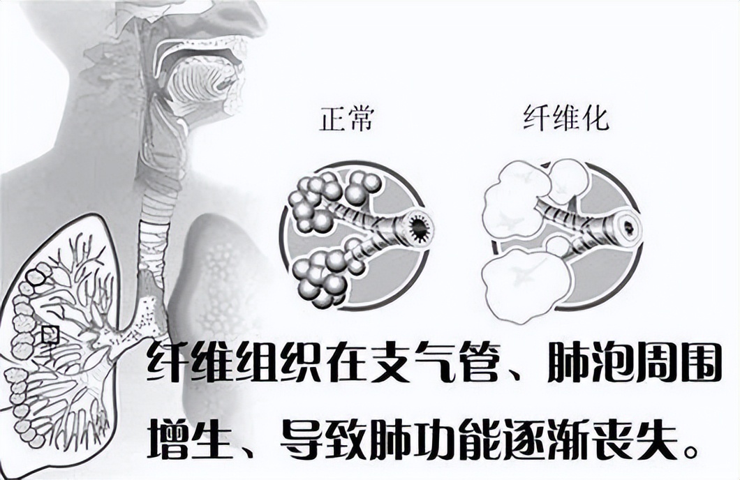 “百草枯女孩”死里逃生！能被救回來，靠的是什么？
