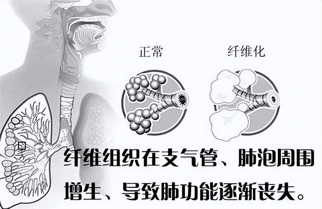 “百草枯女孩”死里逃生！能被救回来，靠的是什么？