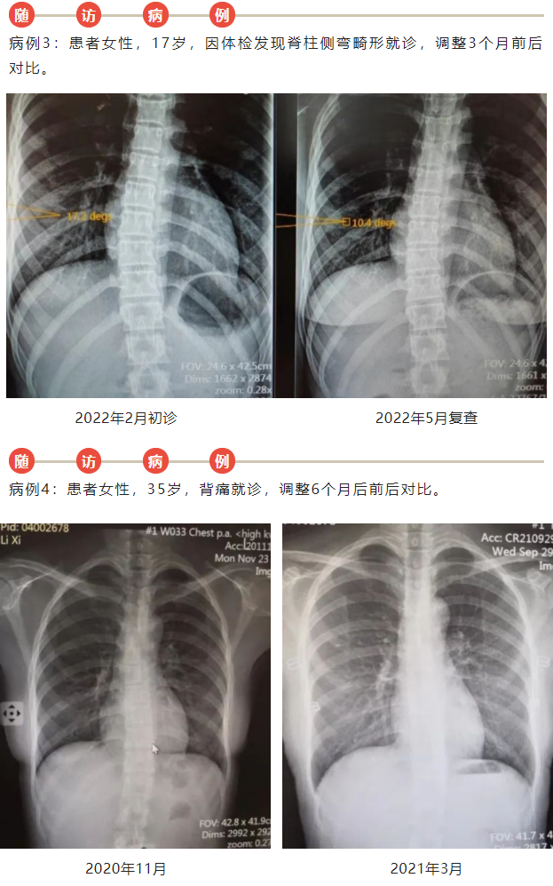 挺直脊梁——中医手法调治特发性脊柱侧弯