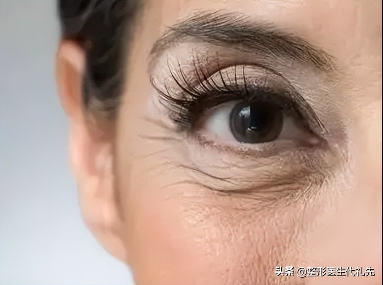 主要是由于皮肤松弛所导致,所以既然找到了主要原因,我们就去解决这个