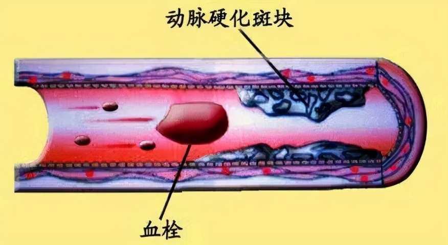 颈动脉斑块，怎么查？怎么治？别吃哪种水果？本文为您全讲清