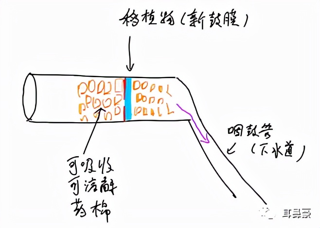 【爱耳日系列科普之中耳炎】中耳炎手术