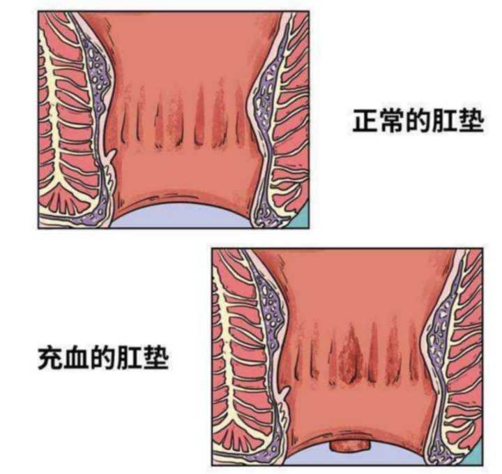 痔疮治疗全解析：不同类型如何对症下药？
