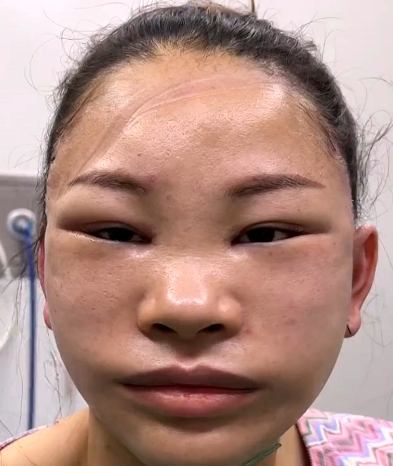 我做完拉皮后后悔死了,丑的自己都不认识了,一个月后惊艳了自己