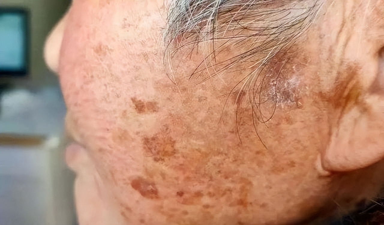红霉素软膏能去除老人斑吗?医生:请提前了解