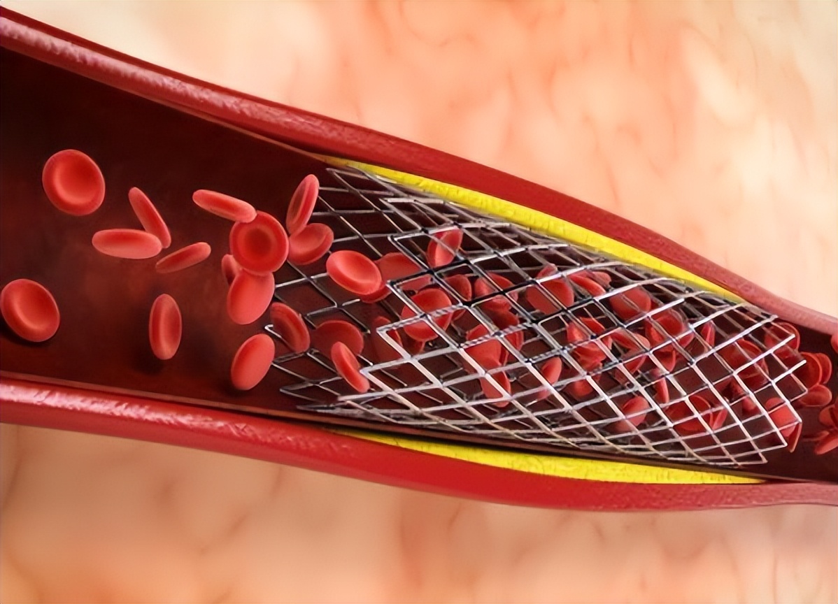 做一个支架需多少费用(从2万降到几百) - 青木春