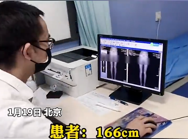 女大学生要求“截骨变矮”，竟是为了要“合群”，真实身高亮了