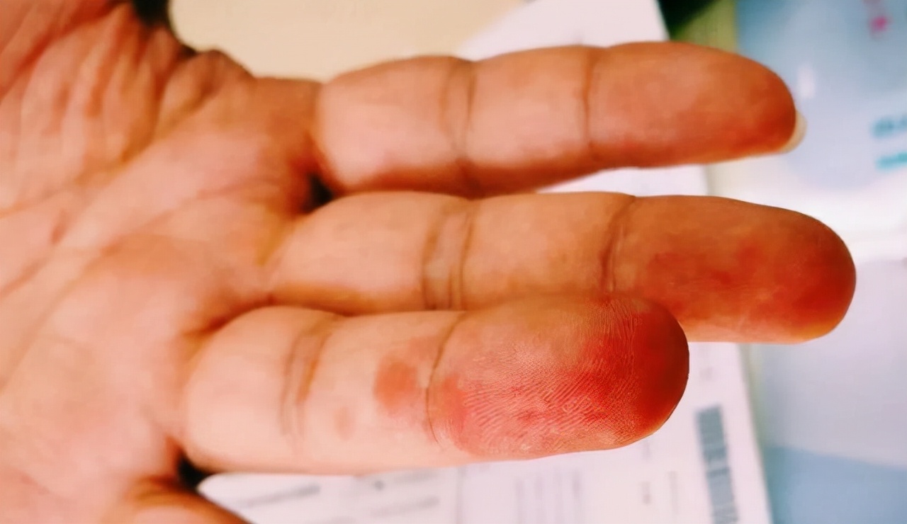 怎样知道血脂高不高？不妨看看手上是否有三个现象，是藏不住的
