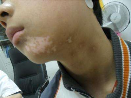 孩子脸上长白斑,先别着急"打虫",对症治疗很重要,以免娃自卑