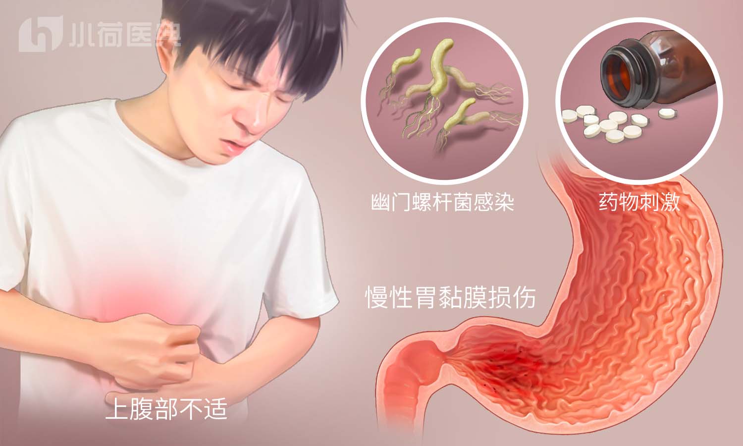 被列为明确致癌物的幽门螺杆菌，到底是什么？