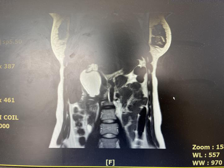 小戳口治大病——腹腔镜下胆总管囊肿切除术+胆总管空肠吻合术
