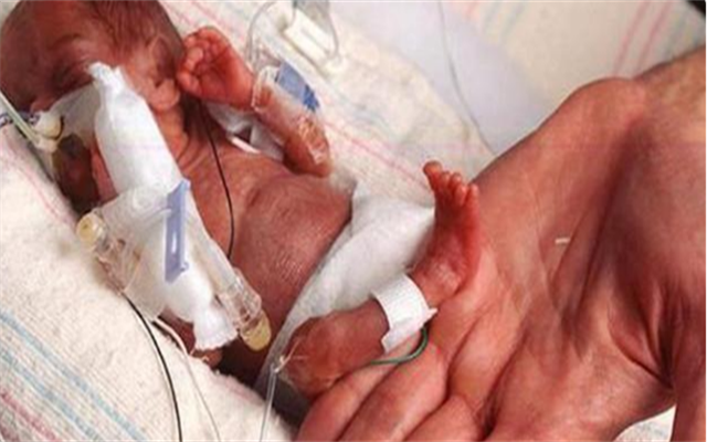 出生仅25厘米的美国拇指姑娘，医生断定不能活过一岁，如今成女神