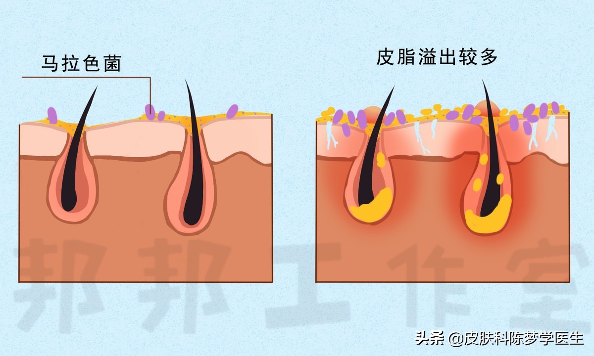 脸上长红斑、脱屑，是银屑病还是脂溢性皮炎？