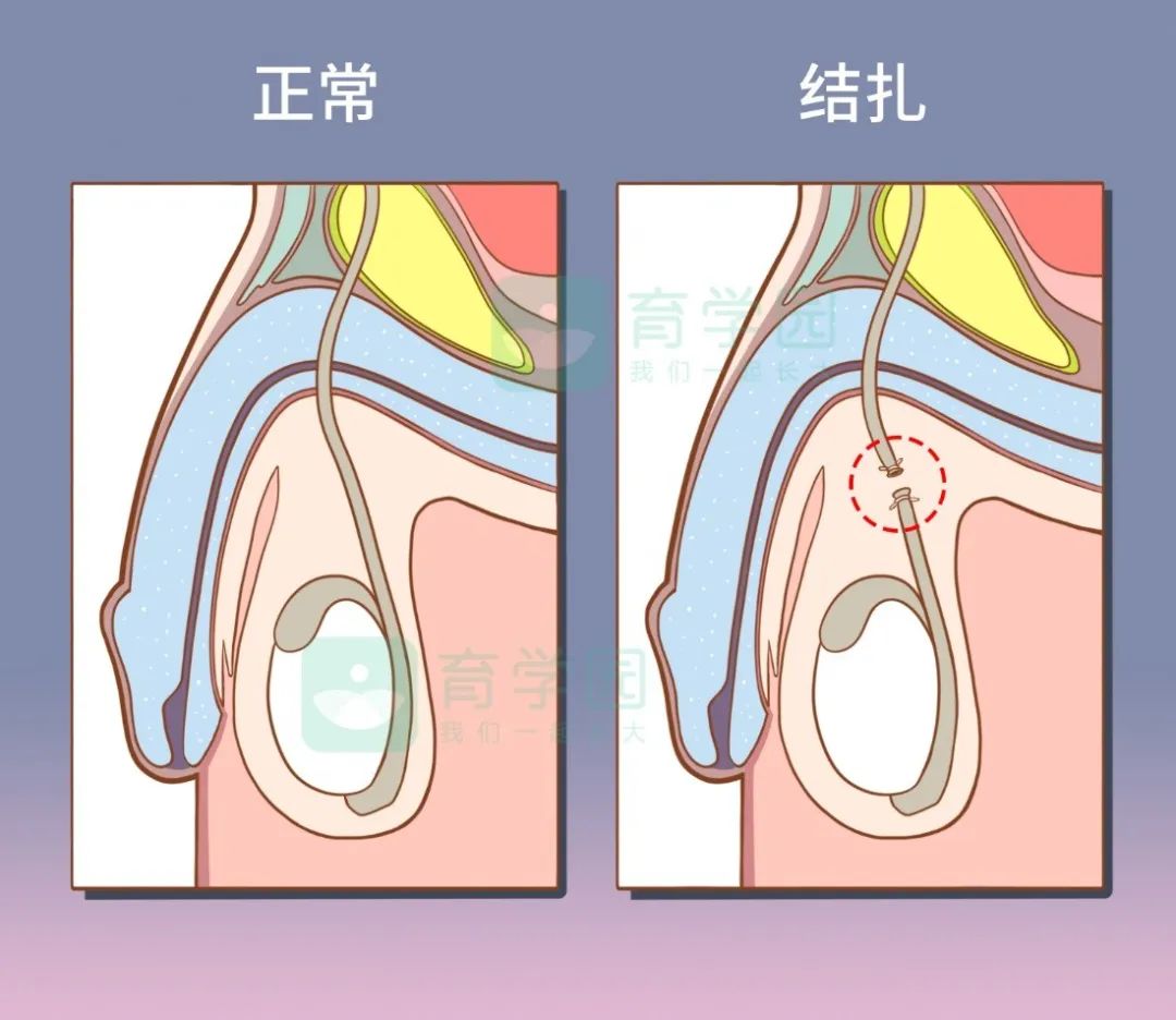 女性做结扎手术需要多少钱男人结扎和女人结扎