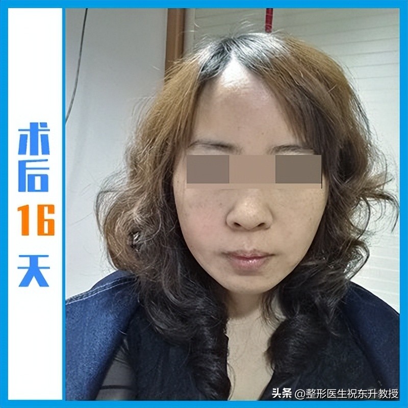 48岁把拉皮手做了，术后16天-120天，无P图 不美颜 真实反馈