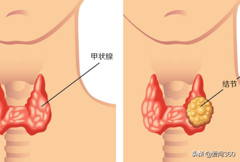甲状腺有问题的几个表现，预防甲状腺结节的小妙招，你知道几个？