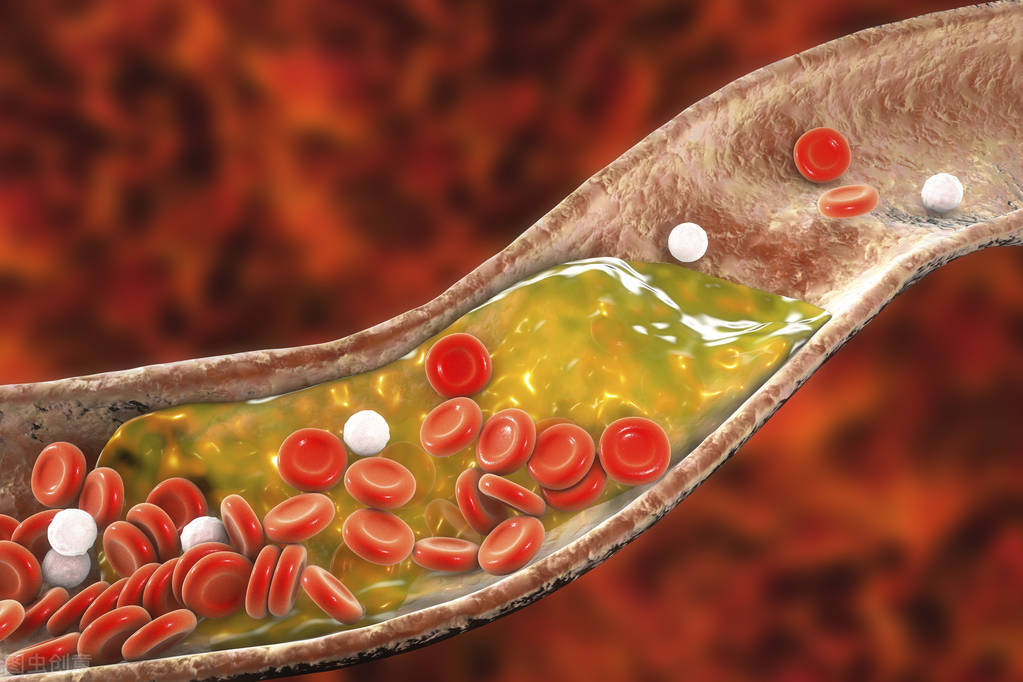 医生坦言：50岁大叔“斑块”消失，他坚持的4大习惯值得借鉴
